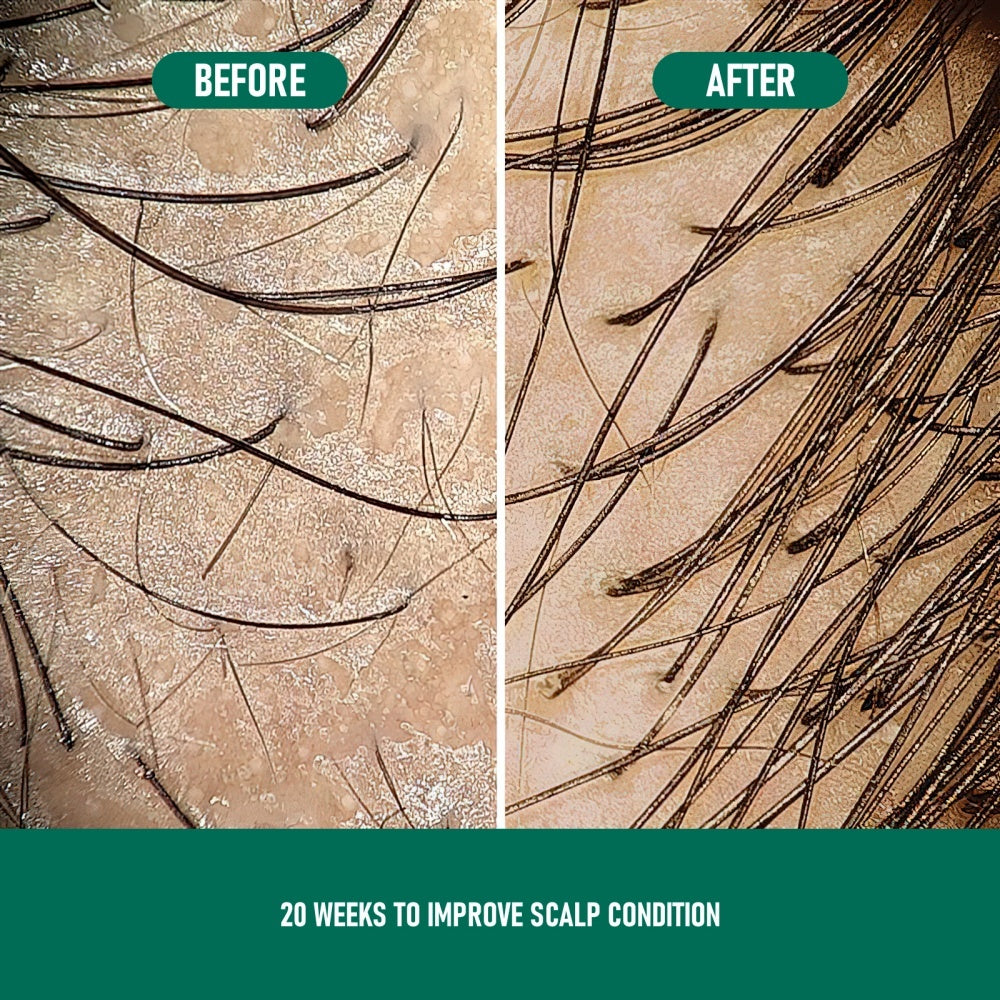 CH004 Minoxidil Anti-Hair Loss Mousse