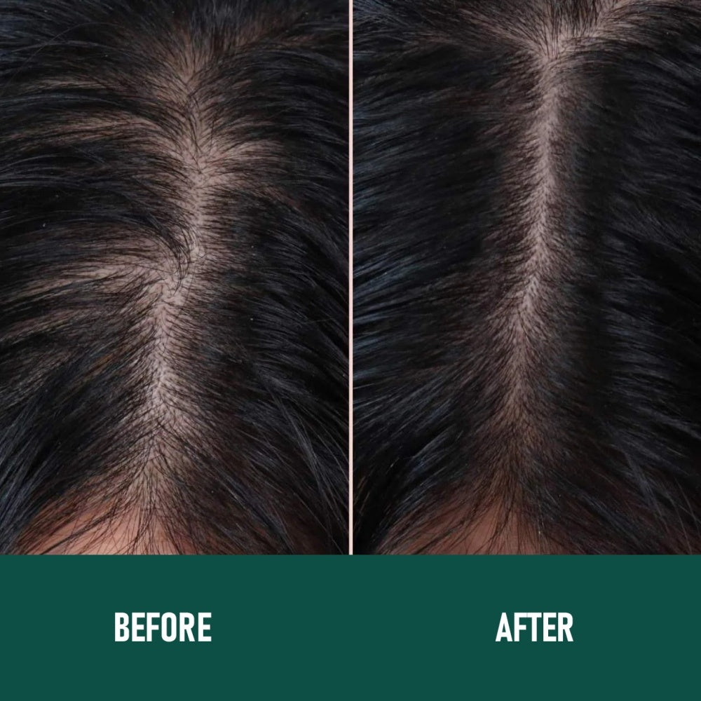 CH004 Minoxidil Anti-Hair Loss Mousse